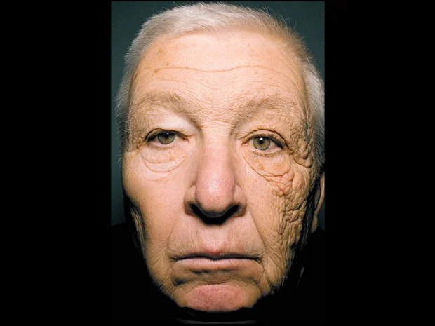 69-godišnji muškarac koji je 28 godina vozio dostavno vozilo — vidljivo oštećenje kože na lijevoj strani lica. Izvor: New England Journal of Medicine